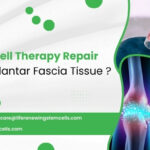 Can Stem Cell Therapy Repair Damaged Plantar Fascia Tissue?